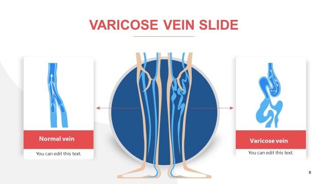 Varicose PowerPoint Diagrams of Veins